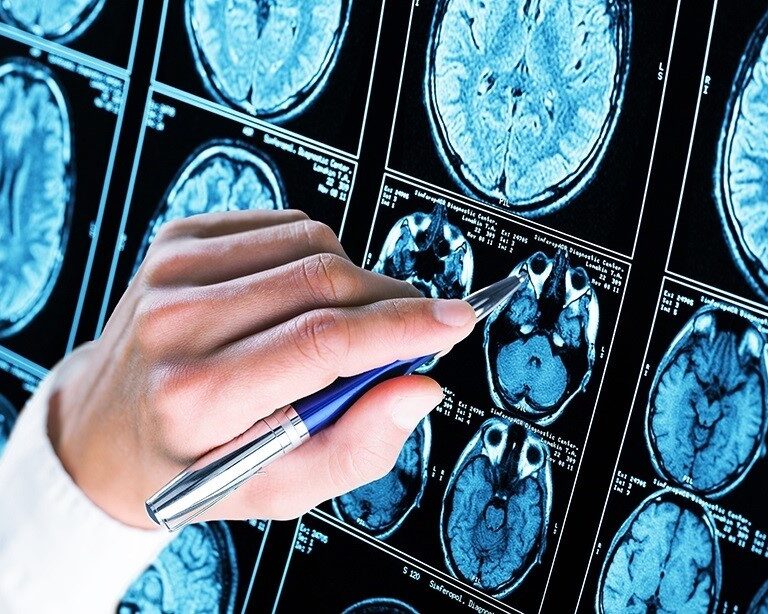 Descubren una variante genética que protege del alzhéimer y otras demencias