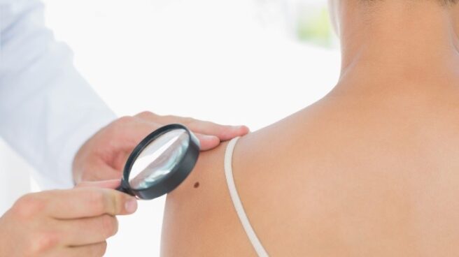 Fotoprotección, revisiones y autoexploración evitarían nueve de cada 10 cánceres de piel