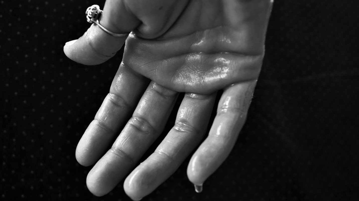 mano hiperhidrosis