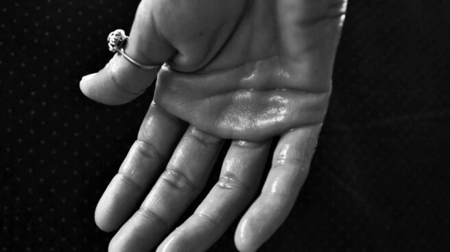 mano hiperhidrosis mano hiperhidrosis