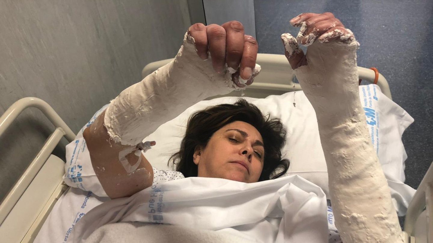 La directiva Rosa García, en el hospital tras romperse las dos muñecas en un accidente.