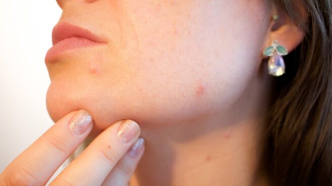 Seis claves contra el 'maskné', el acné producido por el uso de la mascarilla