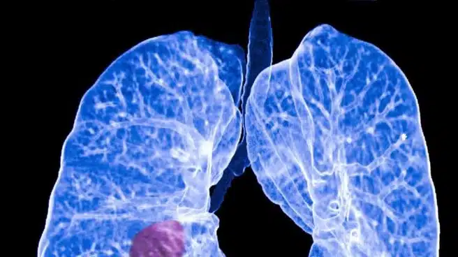 Nuevo enfoque de tratamiento que curaría al 30% de los pacientes con cáncer de pulmón