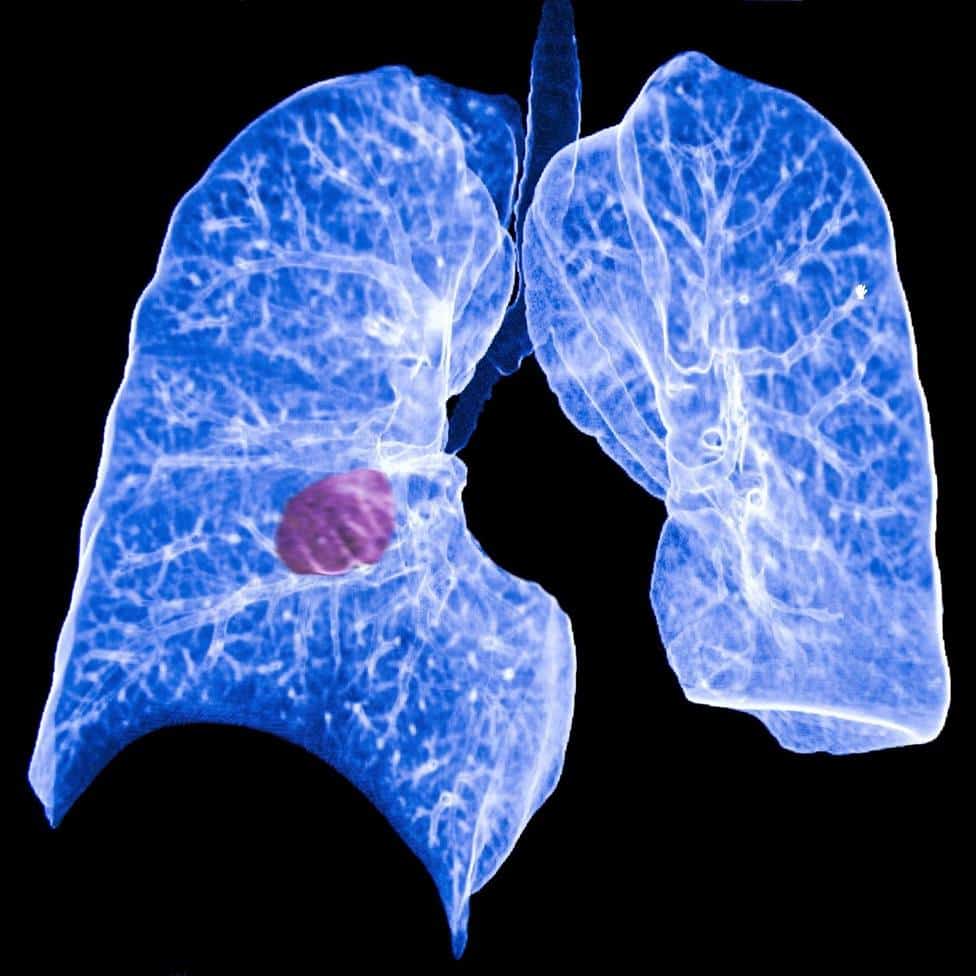Imagen de archivo de un pulmón