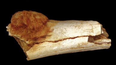 Qué es el osteosarcoma: síntomas, pronóstico y tratamiento