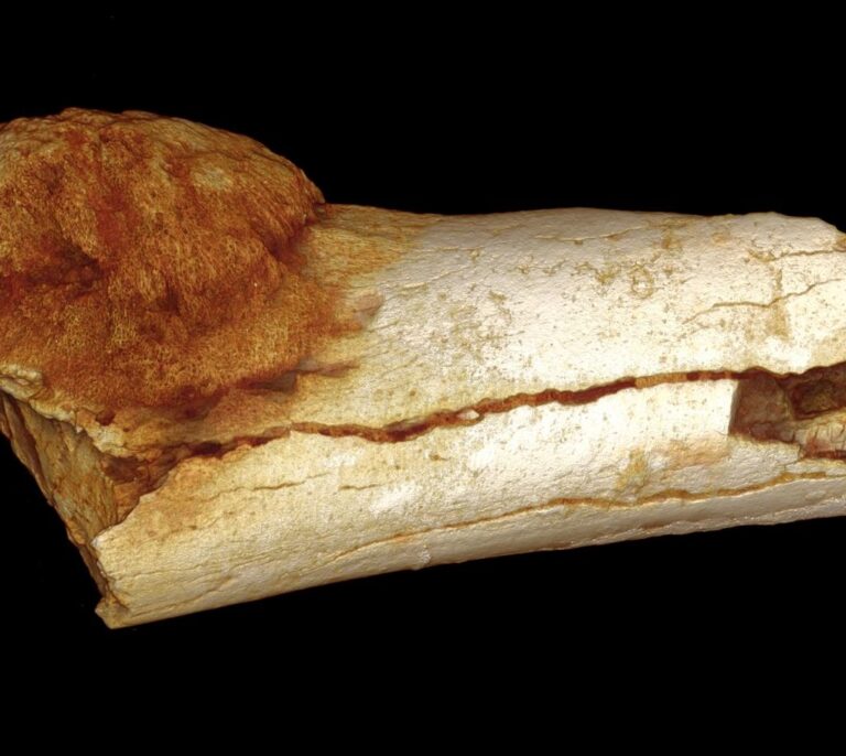 Qué es el osteosarcoma: síntomas, pronóstico y tratamiento