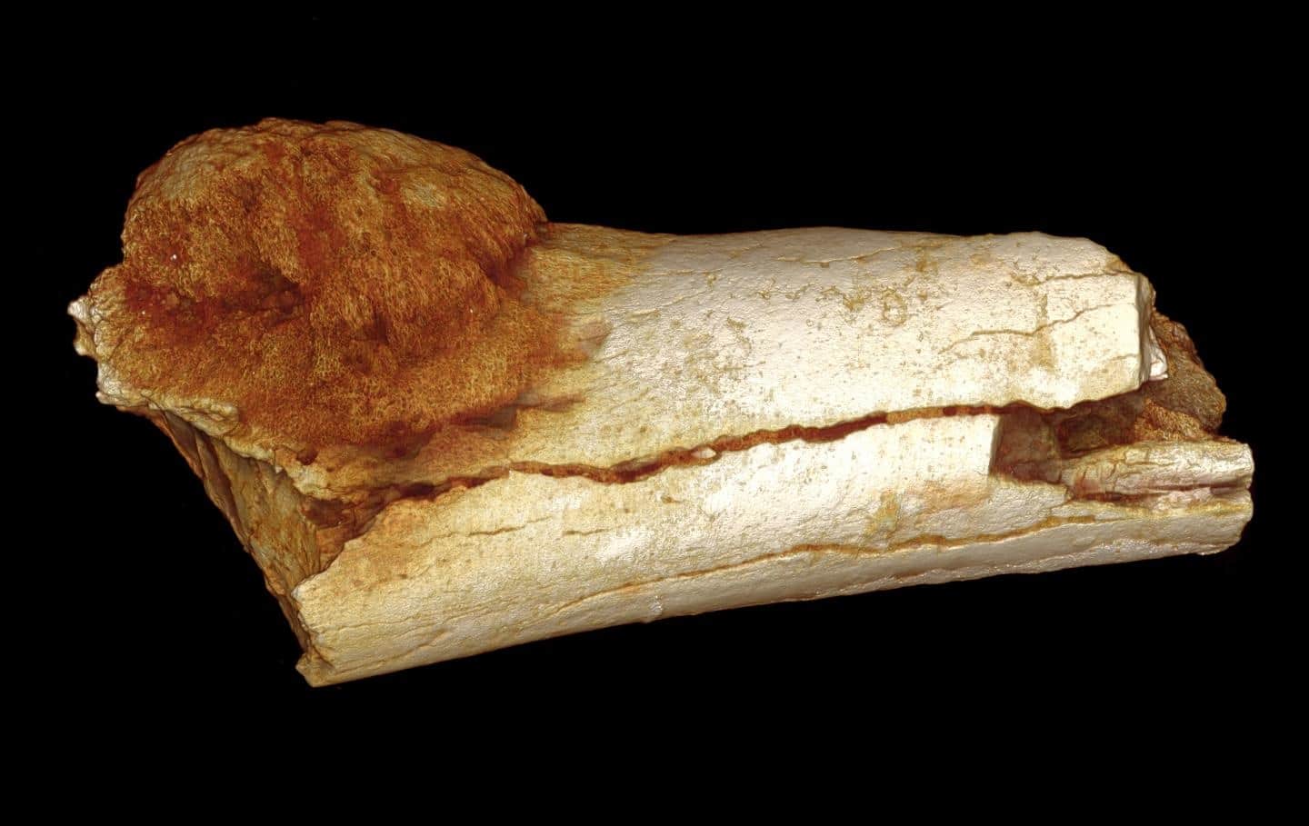 Qué es el osteosarcoma: síntomas, pronóstico y tratamiento