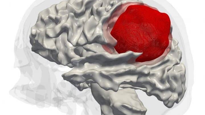 Descubren el talón de Aquiles del cáncer cerebral más frecuente y agresivo