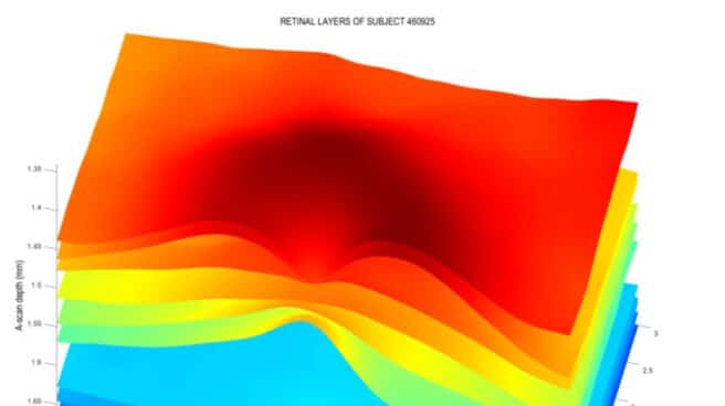 retina alzheimer