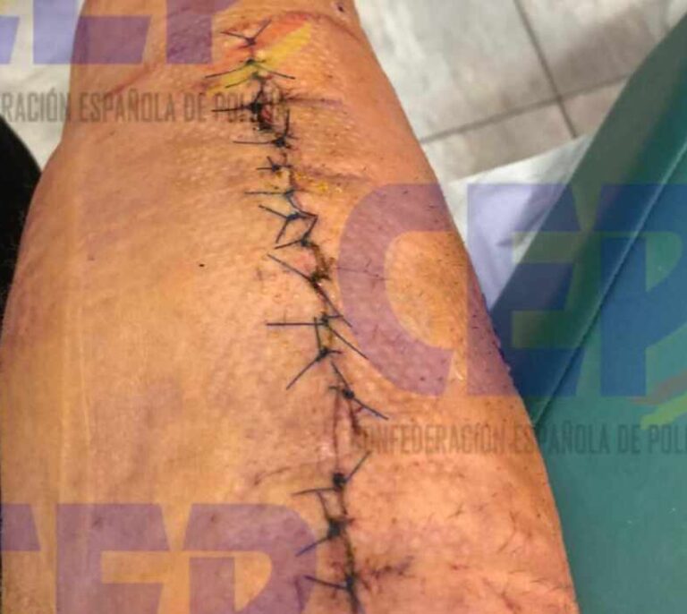 Las cicatrices de un 'antidisturbios' de la Policía Nacional herido en Barcelona