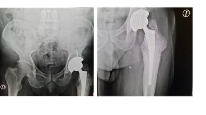 Una de las prótesis defectuosas distribuidas por Johnson & Johnson e implantada a un paciente de Canarias. El Independiente.