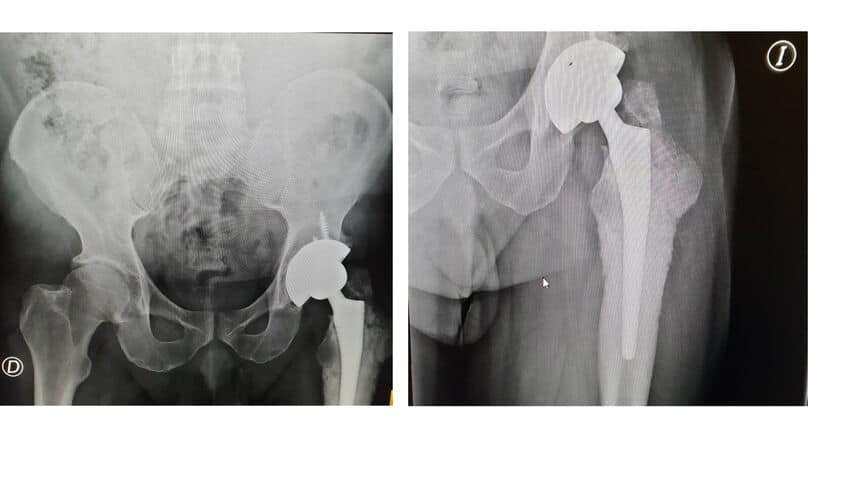 Una de las prótesis defectuosas distribuidas por Johnson & Johnson e implantada a un paciente de Canarias. El Independiente.