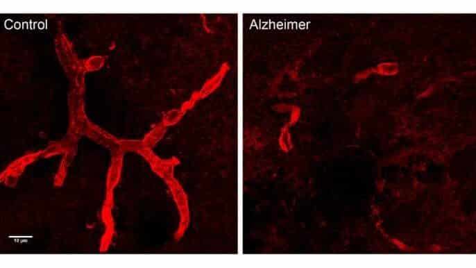 Un anticoagulante logra retrasar la aparición del alzhéimer en ratones