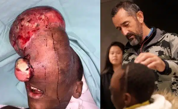 El último 'milagro' de Pedro Cavadas: extirpa a un niño un tumor en la cabeza