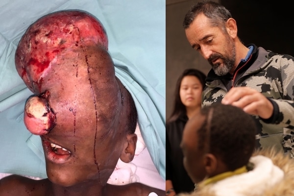 El último 'milagro' de Pedro Cavadas: extirpa a un niño un tumor en la cabeza