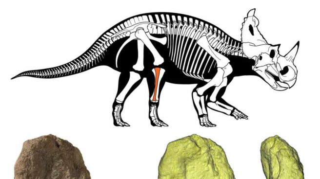 La masa tumoral principal está en la parte superior del hueso y se puede ver en la reconstrucción 3D en amarillo. La masa tumoral principal está en la parte superior del hueso y se puede ver en la reconstrucción 3D en amarillo.