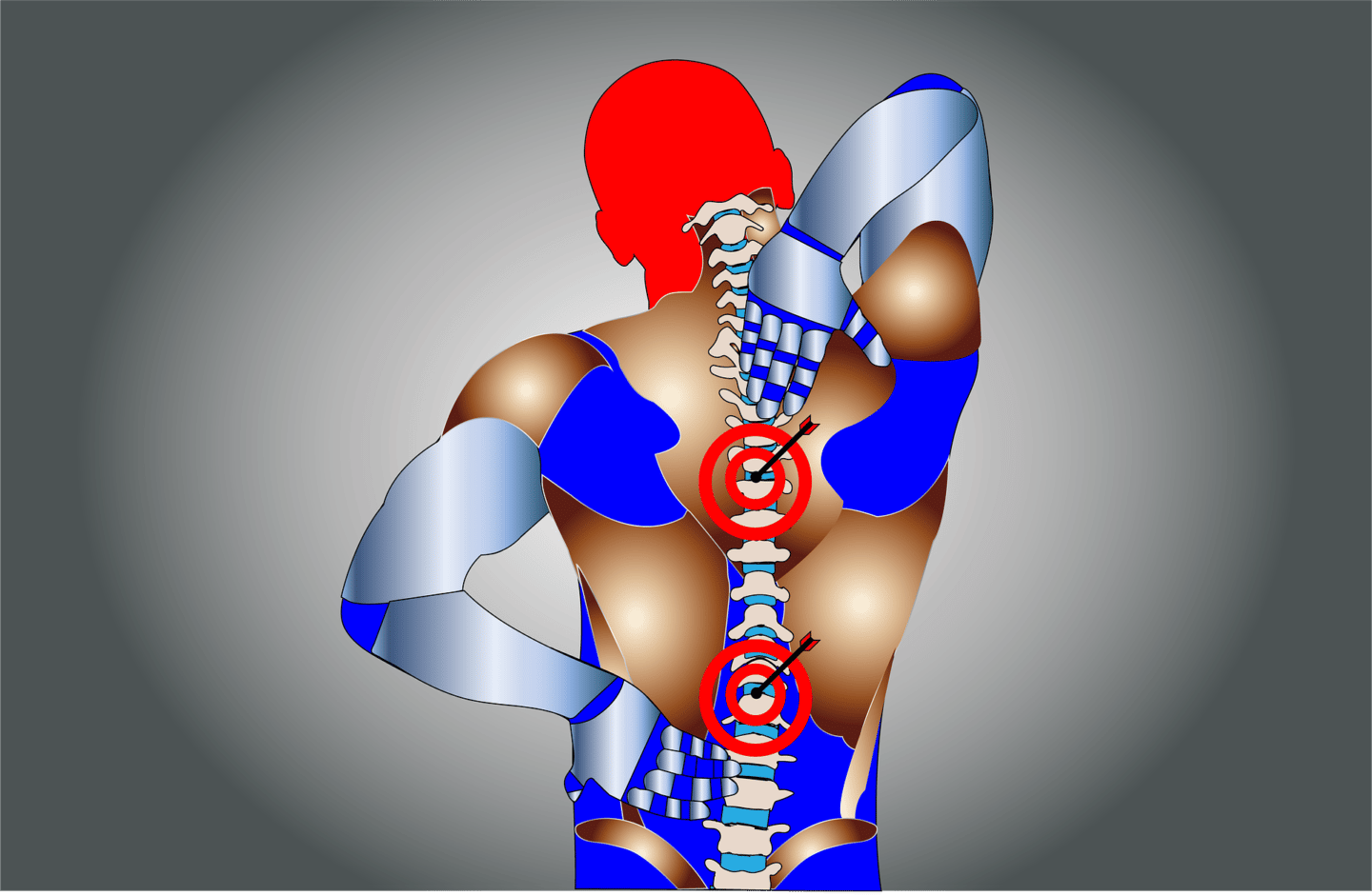 ¿Por qué las hernias discales pueden ser frecuentes entre deportistas?