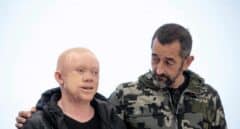 Guineano albino operado por Cavadas: "Al subir al avión, recuperé la esperanza"