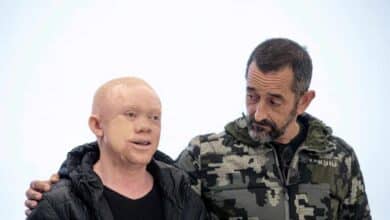Guineano albino operado por Cavadas: "Al subir al avión, recuperé la esperanza"