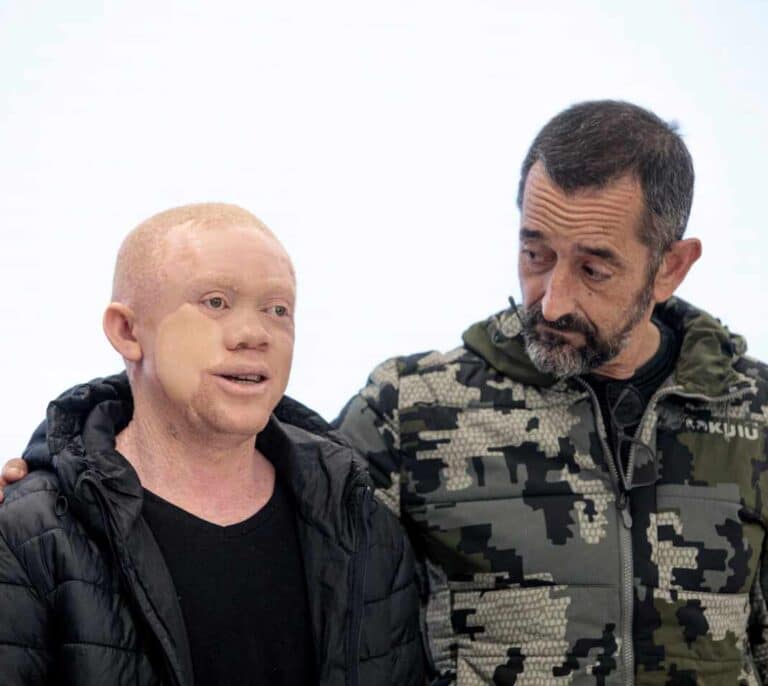 Guineano albino operado por Cavadas: "Al subir al avión, recuperé la esperanza"