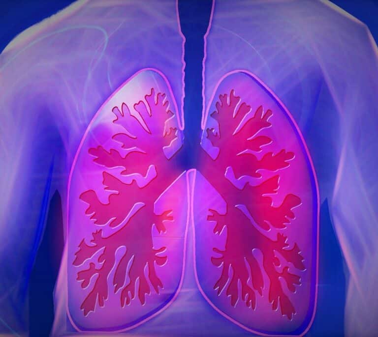 ¿En qué consiste la Fibrosis Quística?