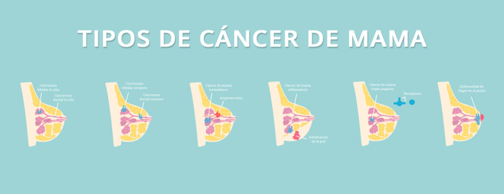 Tipos de cáncer de mama
