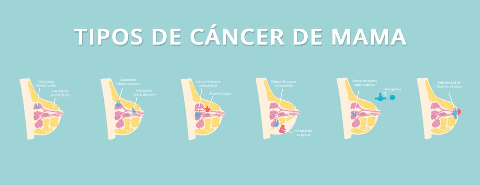 ¿Cáncer de mama o mastitis? Conoce las enfermedades de la mama para