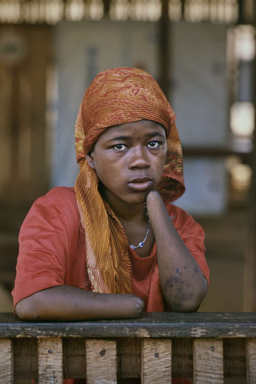 Mariatu Kamara, de 15 años, sufrió la amputación en 1999 de sus dos manos durante la guerra de Sierra Leona. Cortar manos, piernas, orejas o lenguas se convirtió en una práctica habitual de la guerrilla. La amputación fue la macabra singularidad de la guerra sierraleonesa. La guerrilla del Frente Revolucionario Unido generalizó su práctica a partir de 1995. Daba igual la edad. Algunas víctimas tenían meses. Mariatu lleva años viviendo en un centro especial para amputados en Aberdeen, un barrio de Freetown, la capital sierraleonesa. Aquí ha tenido tuvo su primer hijo que ha muerto al poco de nacer. Freetown (Sierra Leona), enero de 2001