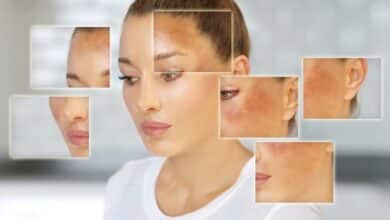 ¿Manchadas por el sol? Cómo prevenir y tratar el melasma