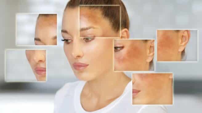 Nueve de cada diez mujeres pueden llegar a presentar melasma en su rostro. Los expertos del servicio de dermatología de Quirónsalud Valencia ofrecen algunas claves para eliminar y prevenir las manchas.