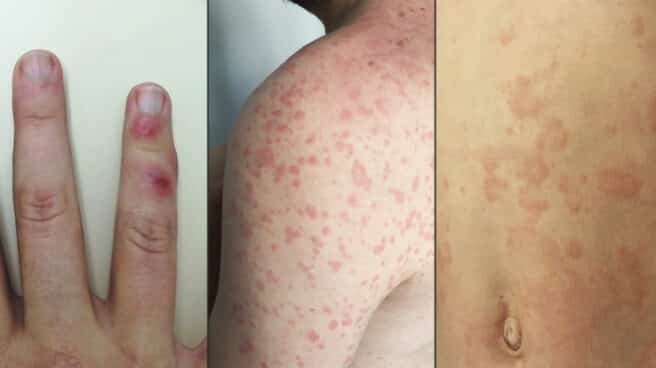 Los efectos del coronavirus en la piel