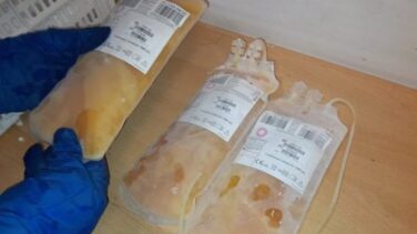 El plasma de pacientes recuperados de COVID-19 podría ayudar a evitar la hospitalización, según un estudio