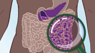 Investigadores hallan un método de detección precoz para el cáncer de páncreas