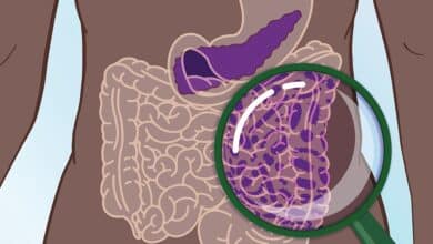 Investigadores hallan un método de detección precoz para el cáncer de páncreas