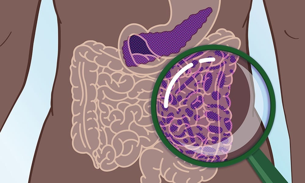 Investigadores hallan un método de detección precoz para el cáncer de páncreas