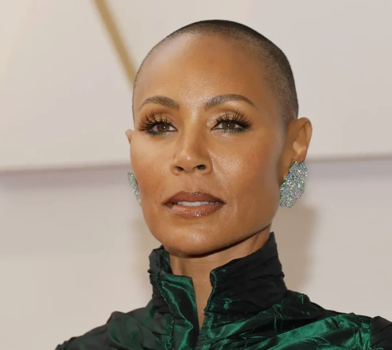 Alopecia cicatricial de origen autoinmune: la enfermedad que padece Jada Pinkett, mujer de Will Smith
