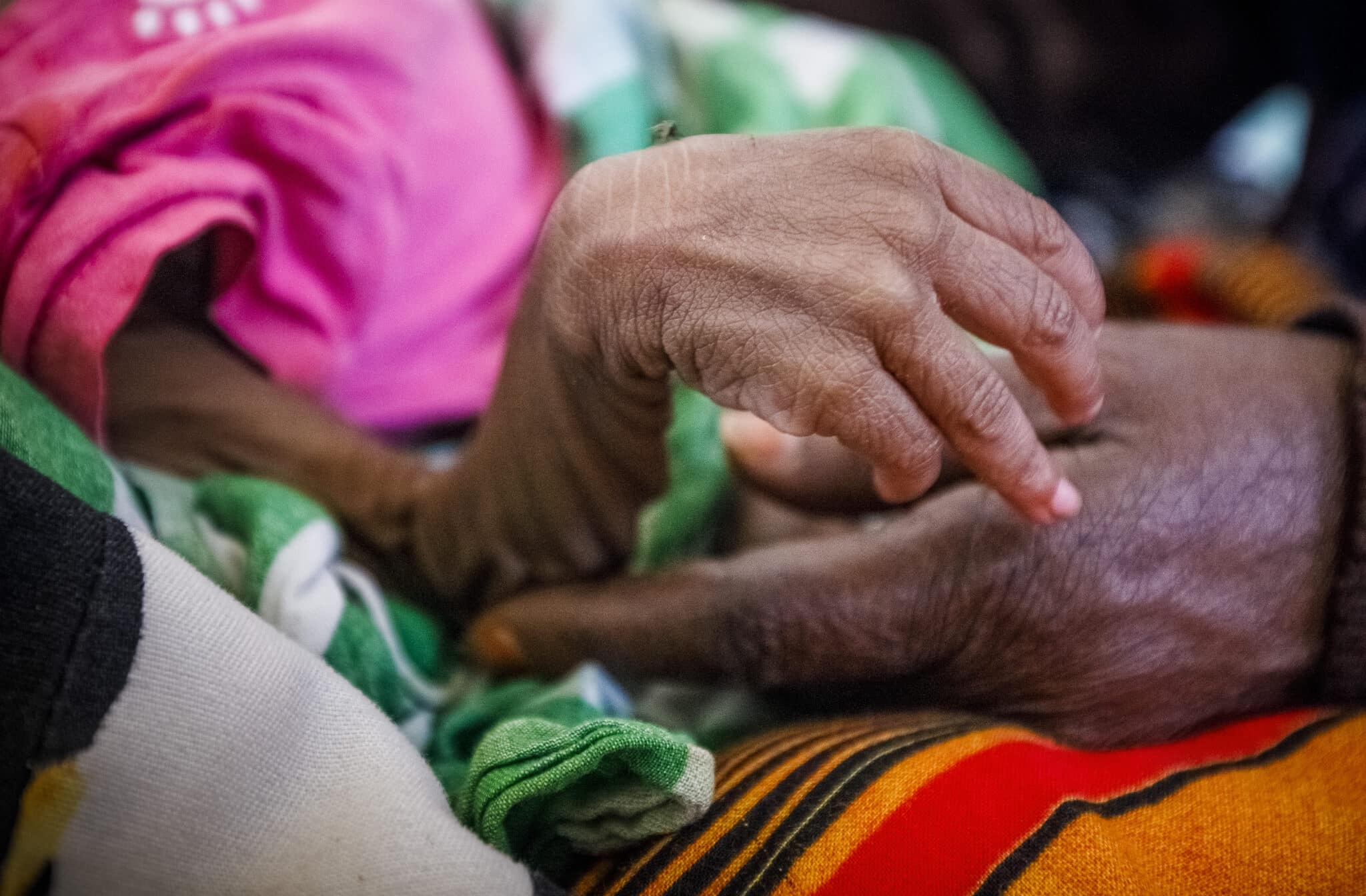 Una niña hospitalizada por desnutrición.