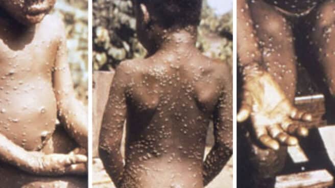 Imagen de un niño afectado por la enfermedad Viruela del mono