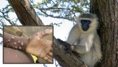 Fernando De la Calle (SEIMC), sobre la viruela del mono: "Igual habría que ser más estrictos con el aislamiento"