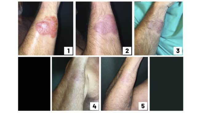 Evolución de una micosis fungoide tratada con pimecrolimus, la crema contra la dermatitis. Evolución de una micosis fungoide tratada con pimecrolimus, la crema contra la dermatitis.