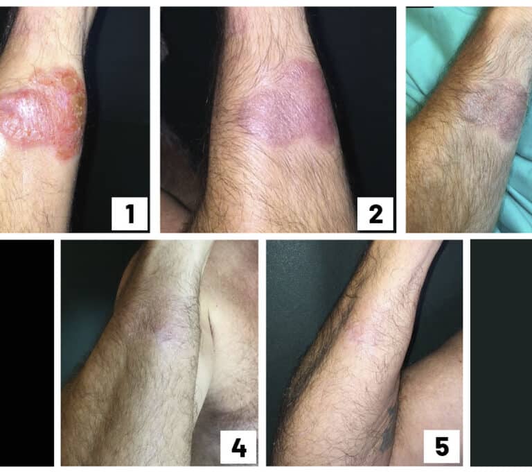 Un ensayo español prueba que una crema contra la dermatitis es eficaz contra un cáncer cutáneo