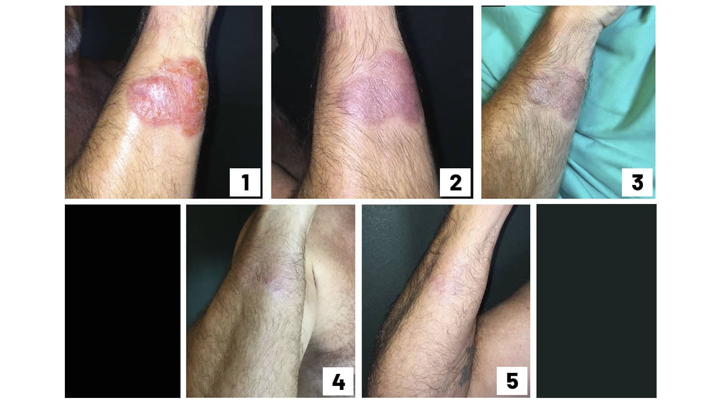 Evolución de una micosis fungoide tratada con pimecrolimus, la crema contra la dermatitis.