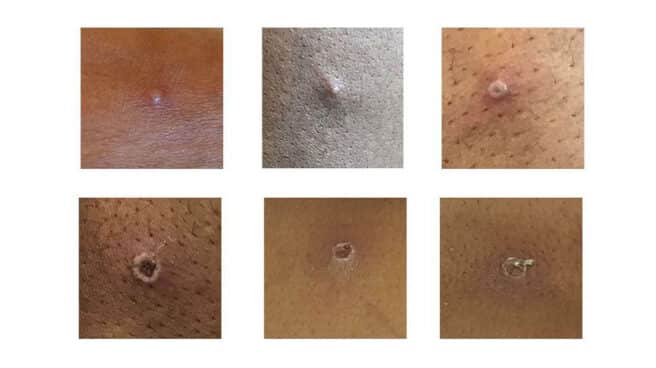 Pústulas viruela del mono Lesiones cutáneas producidas por la viruela del mono