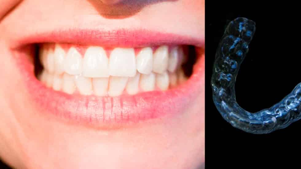 Sanidad advierte sobre la venta 'online' de ortodoncias, que los dentistas llevan años denunciando