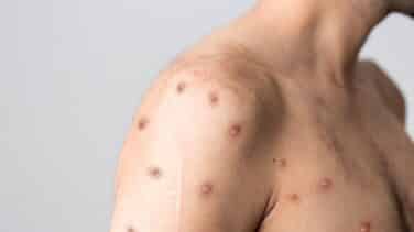 Sanidad se reunirá de urgencia después de que España sea el país de la UE con más casos de viruela del mono en el último mes
