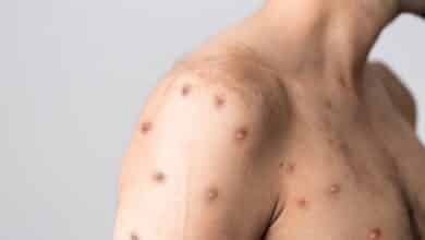 Dermatólogos demuestran que la transmisión de la viruela del mono es por contacto de la piel