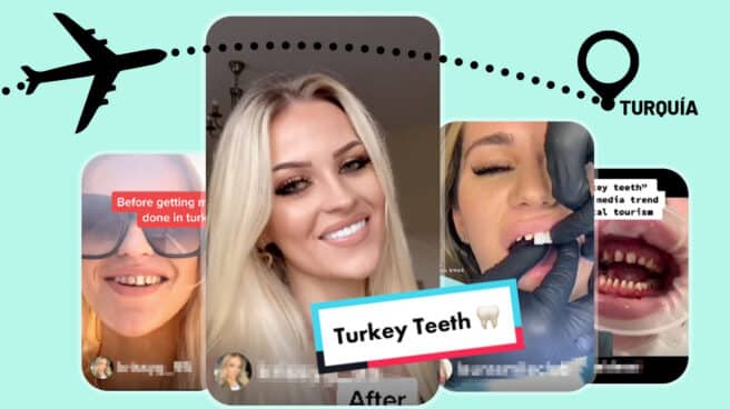 Imágenes de personas que muestran sus tratamientos dentales realizados en Turquía en TikTok