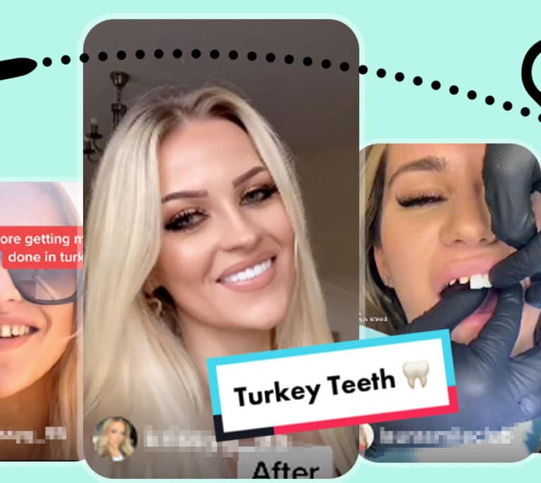Cuidado con los 'dientes turcos': los dentistas alertan de la  última moda en Reino Unido