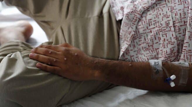 Un enfermo de viruela del mono en un hospital de Perú.