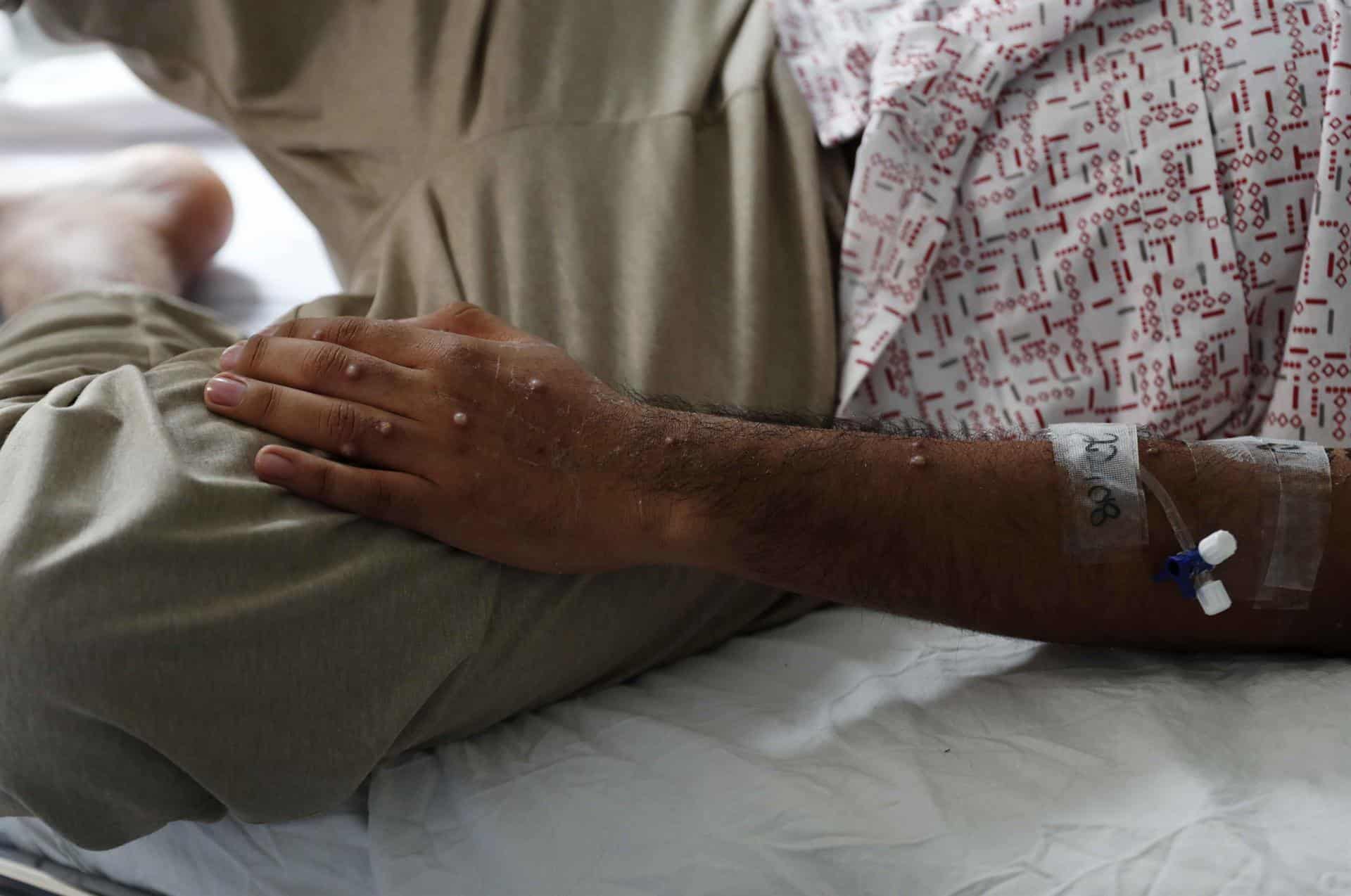 Un enfermo de viruela del mono en un hospital de Perú.